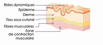 Schéma 2 : Rides dynamiques, lors d’une contraction musculaire.